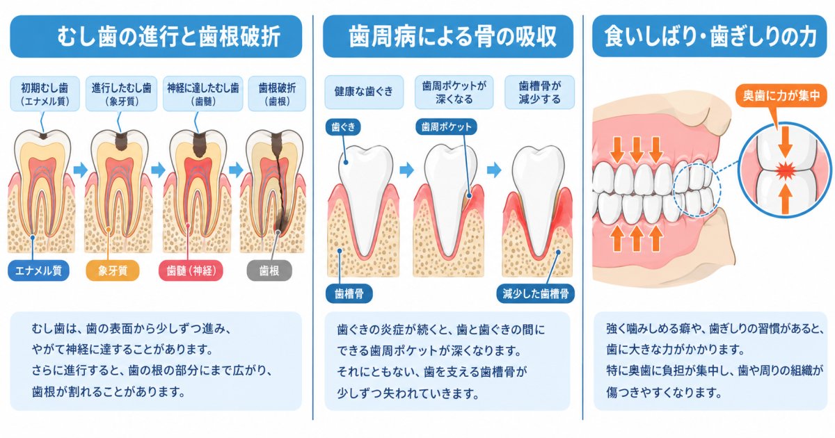歯を失う主な原因とは?むし歯・歯周病と過度な咬合力のメカニズム