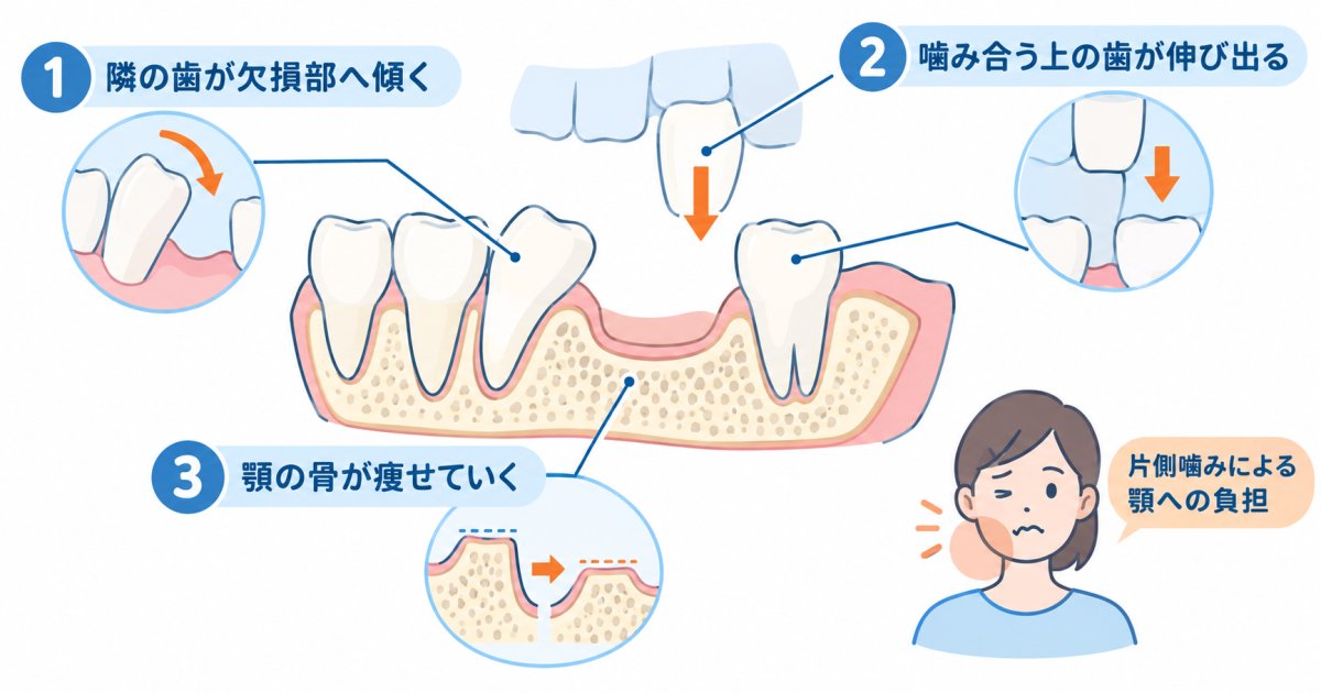奥歯の欠損を放置するとどうなる?口腔内と全身に生じる医学的リスク