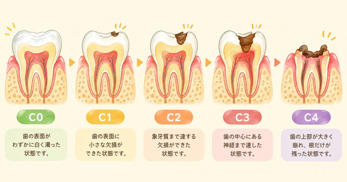むし歯の進行段階と抜歯を検討する境界線